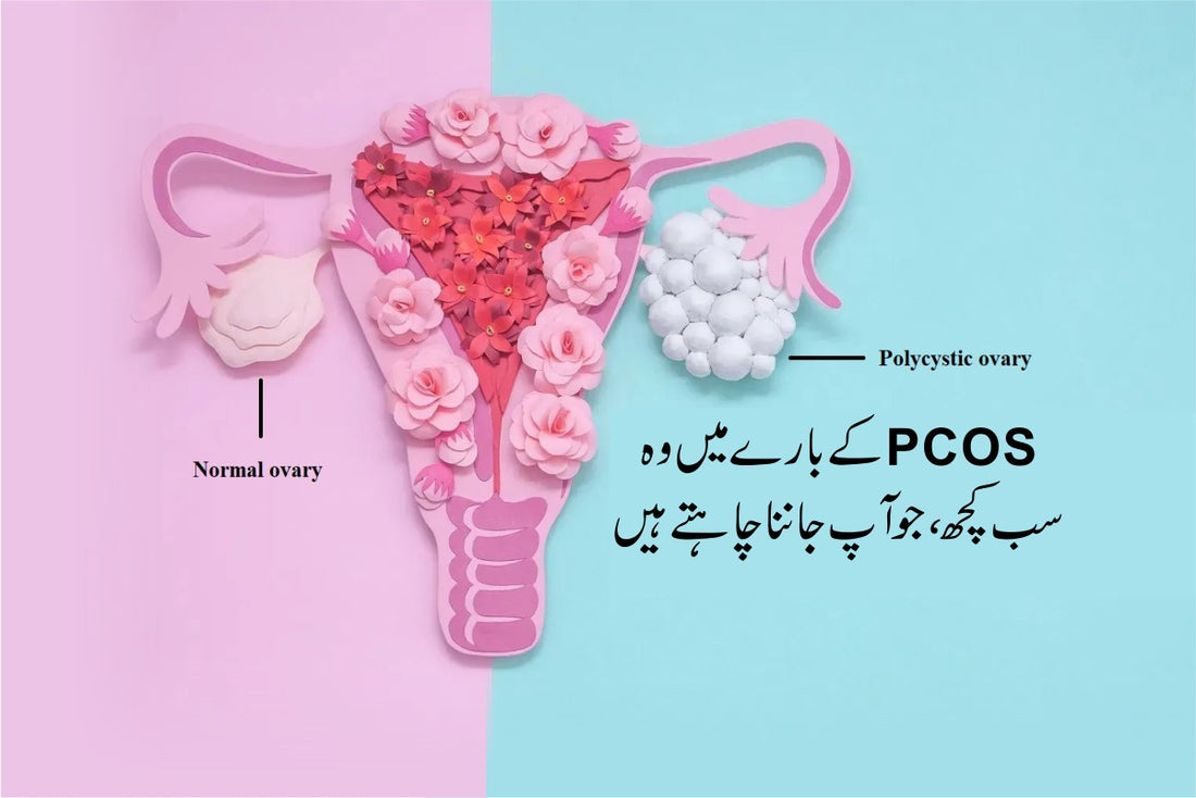 What is PCOS (Polycystic Ovary Syndrome)?